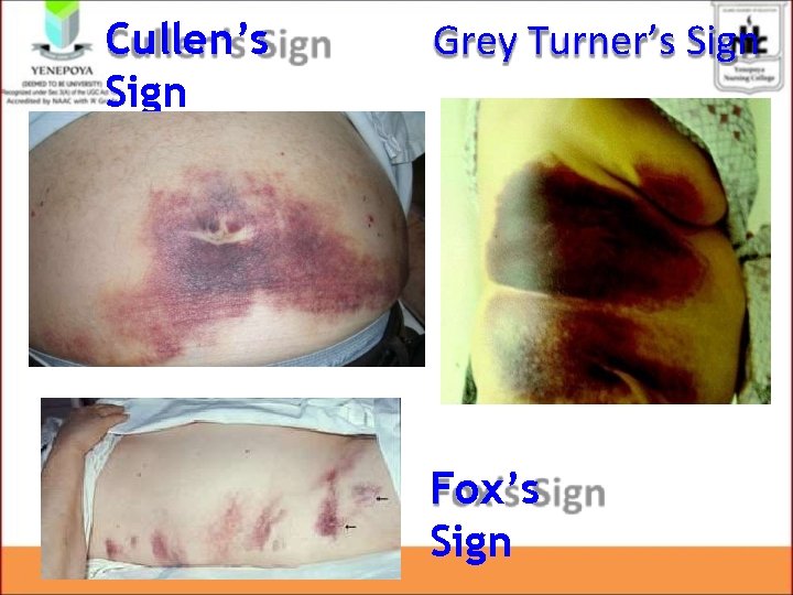 Cullen’s Sign Grey Turner’s Sign Fox’s Sign Cullen’s Sign Grey Turner’s Sign Fox’s Sign