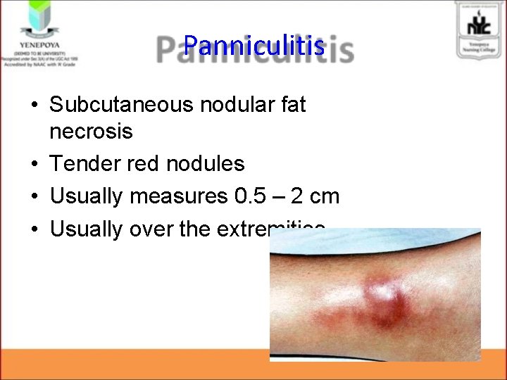 Panniculitis • Subcutaneous nodular fat necrosis • Tender red nodules • Usually measures 0. Panniculitis • Subcutaneous nodular fat necrosis • Tender red nodules • Usually measures 0.