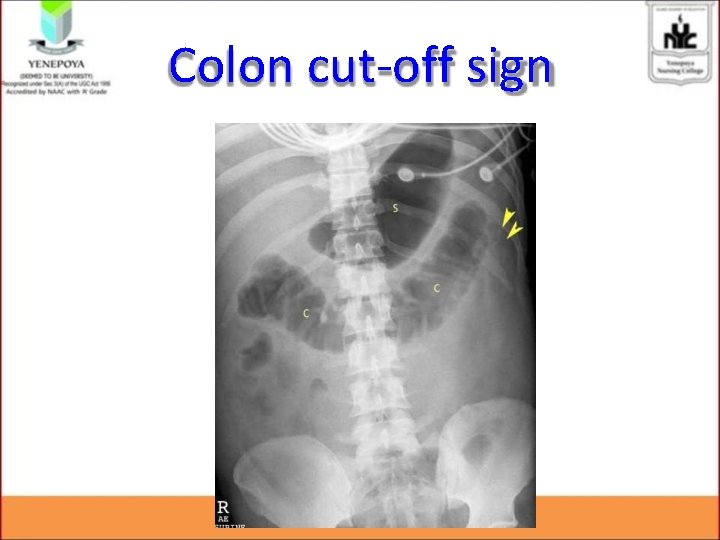 Colon cut-off sign Colon cut-off sign