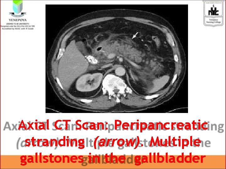 Axial CT Scan: Peripancreatic stranding (arrow). Multiple gallstones in the gallbladder Axial CT Scan: Peripancreatic stranding (arrow). Multiple gallstones in the gallbladder