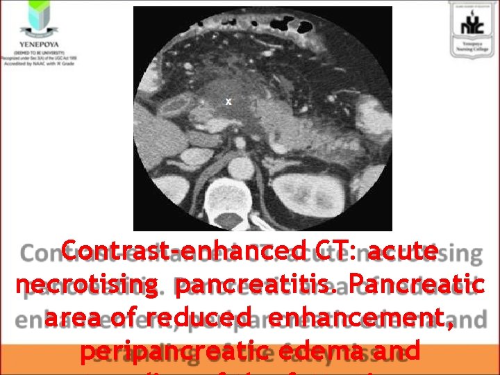 Contrast-enhanced CT: acute necrotising pancreatitis. Pancreatic area of reduced enhancement, peripancreatic edema and Contrast-enhanced CT: acute necrotising pancreatitis. Pancreatic area of reduced enhancement, peripancreatic edema and