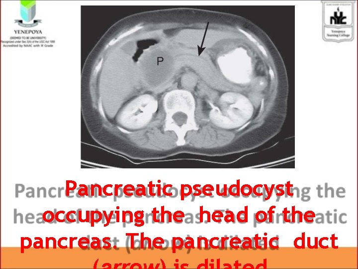 Pancreatic pseudocyst occupying the head of the pancreas. The pancreatic duct Pancreatic pseudocyst occupying the head of the pancreas. The pancreatic duct