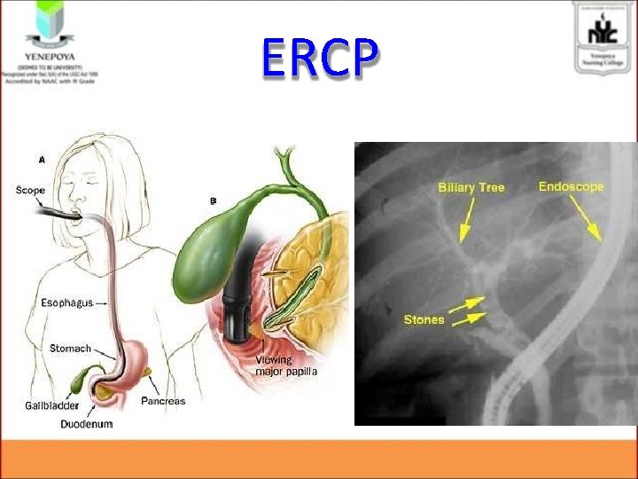 ERCP ERCP