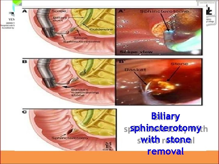 Biliary sphincterotomy with stone removal Biliary sphincterotomy with stone removal