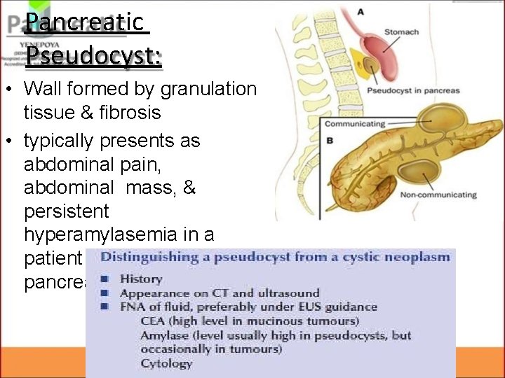 Pancreatic Pseudocyst: • Wall formed by granulation tissue & fibrosis • typically presents as Pancreatic Pseudocyst: • Wall formed by granulation tissue & fibrosis • typically presents as