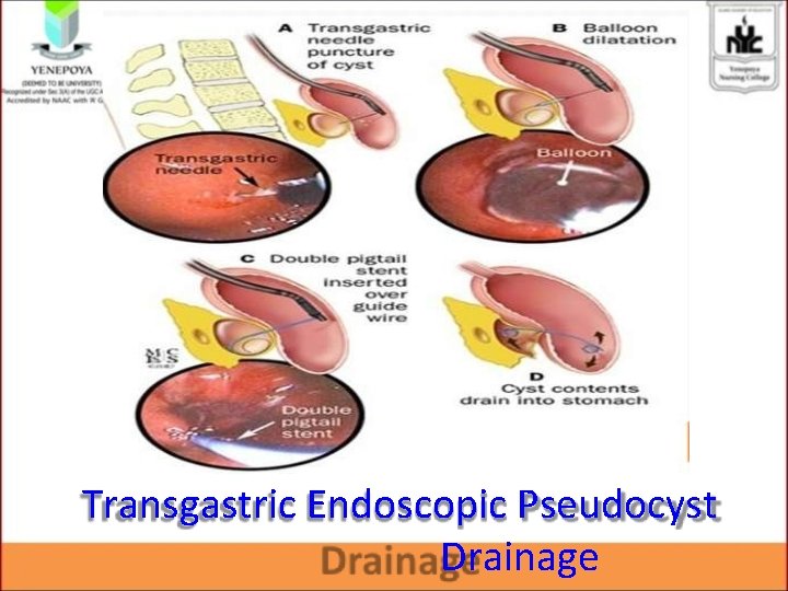 Transgastric Endoscopic Pseudocyst Drainage Transgastric Endoscopic Pseudocyst Drainage