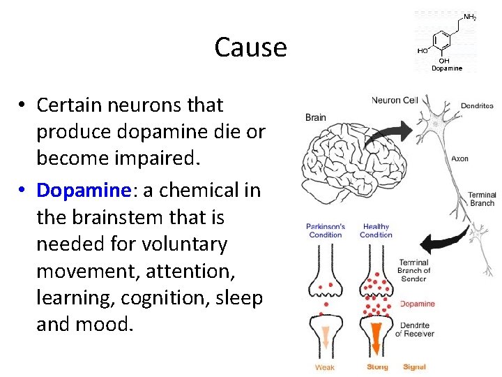 Cause • Certain neurons that produce dopamine die or become impaired. • Dopamine: a