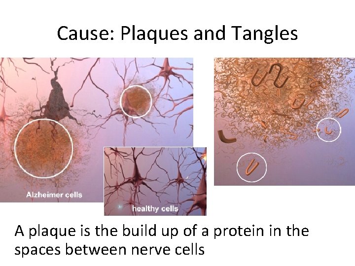 Cause: Plaques and Tangles A plaque is the build up of a protein in