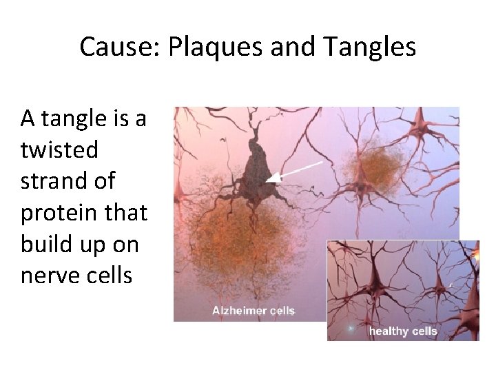 Cause: Plaques and Tangles A tangle is a twisted strand of protein that build