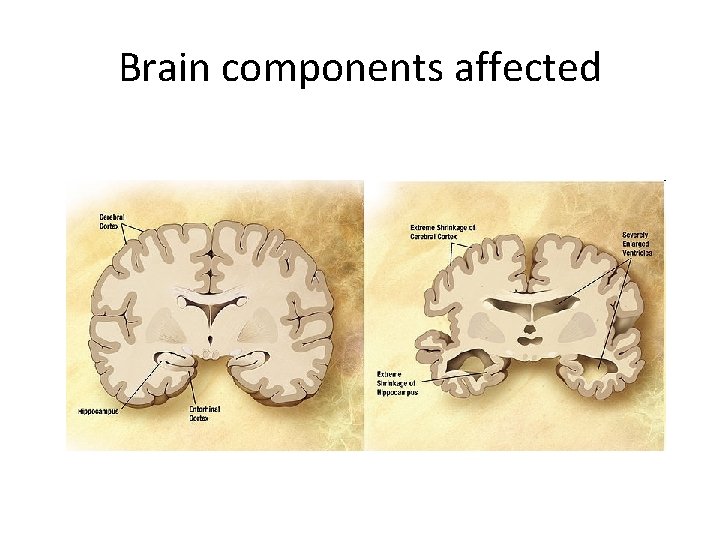 Brain components affected 