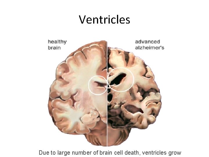 Ventricles Due to large number of brain cell death, ventricles grow 