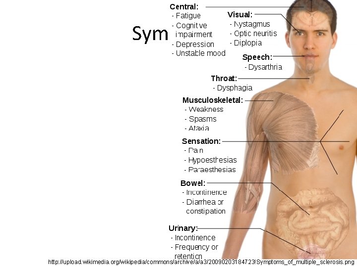 Symptoms http: //upload. wikimedia. org/wikipedia/commons/archive/a/a 3/20090203184723!Symptoms_of_multiple_sclerosis. png 