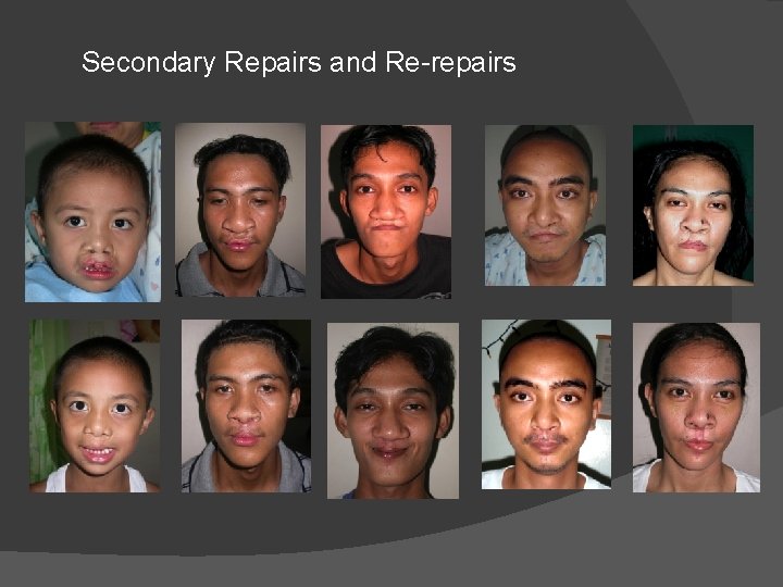 Secondary Repairs and Re-repairs Secondary Repairs and Re-repairs