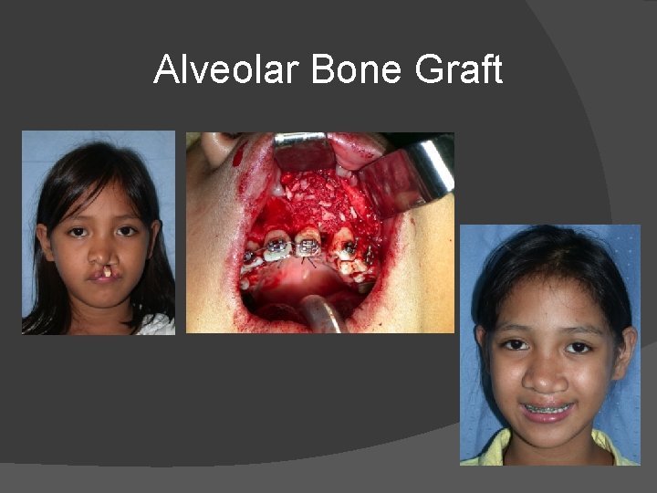 Alveolar Bone Graft Alveolar Bone Graft