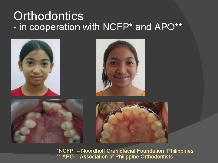 Orthodontics - in cooperation with NCFP* and APO** *NCFP – Noordhoff Craniofacial Foundation, Philippines Orthodontics - in cooperation with NCFP* and APO** *NCFP – Noordhoff Craniofacial Foundation, Philippines