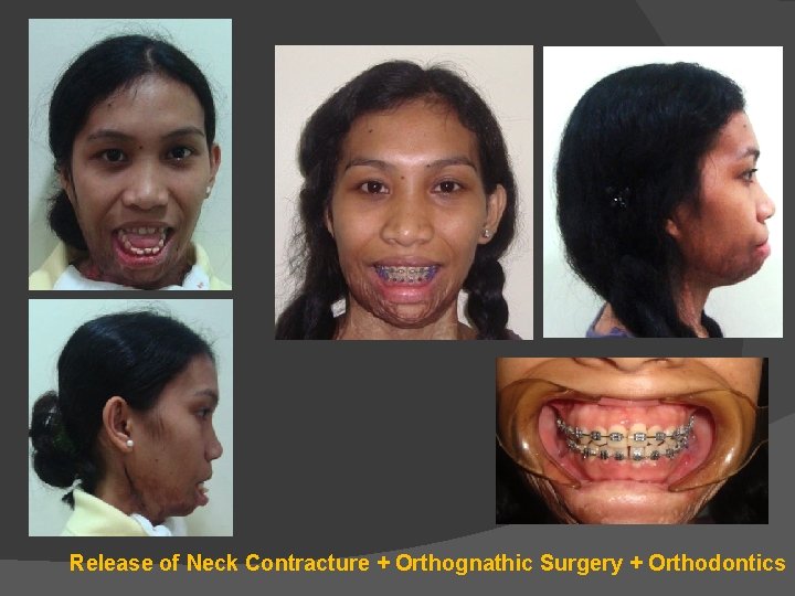 Release of Neck Contracture + Orthognathic Surgery + Orthodontics Release of Neck Contracture + Orthognathic Surgery + Orthodontics