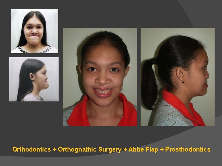 Orthodontics + Orthognathic Surgery + Abbe Flap + Prosthodontics Orthodontics + Orthognathic Surgery + Abbe Flap + Prosthodontics