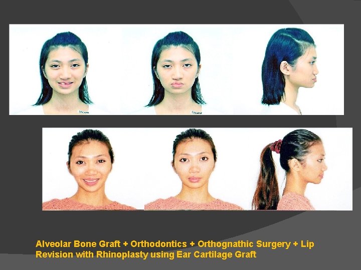 Alveolar Bone Graft + Orthodontics + Orthognathic Surgery + Lip Revision with Rhinoplasty using Alveolar Bone Graft + Orthodontics + Orthognathic Surgery + Lip Revision with Rhinoplasty using