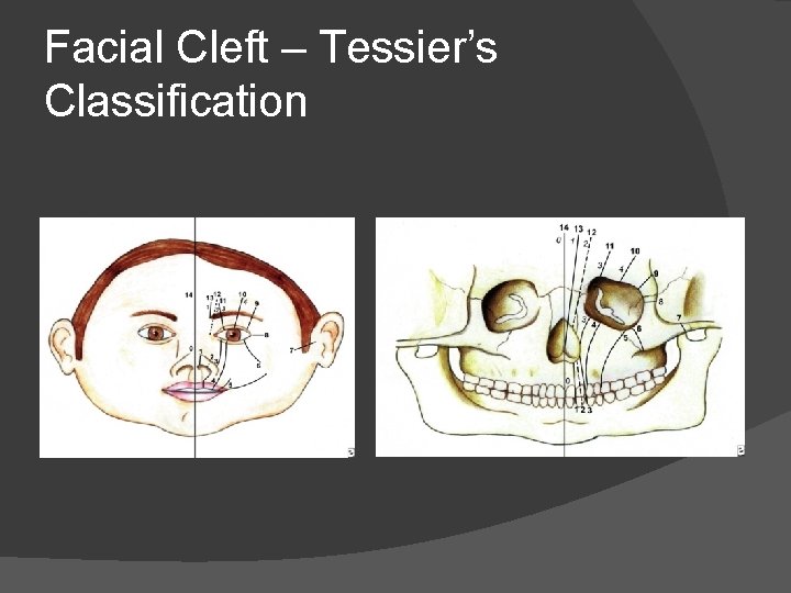 Facial Cleft – Tessier’s Classification Facial Cleft – Tessier’s Classification
