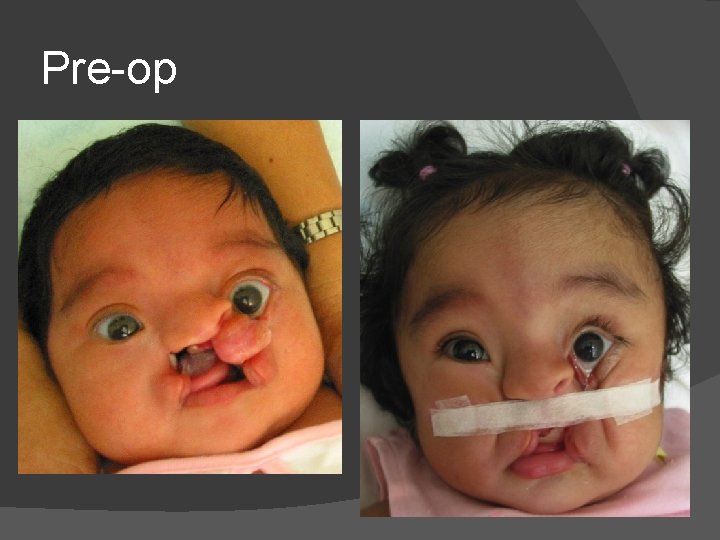 Pre-op Pre-op