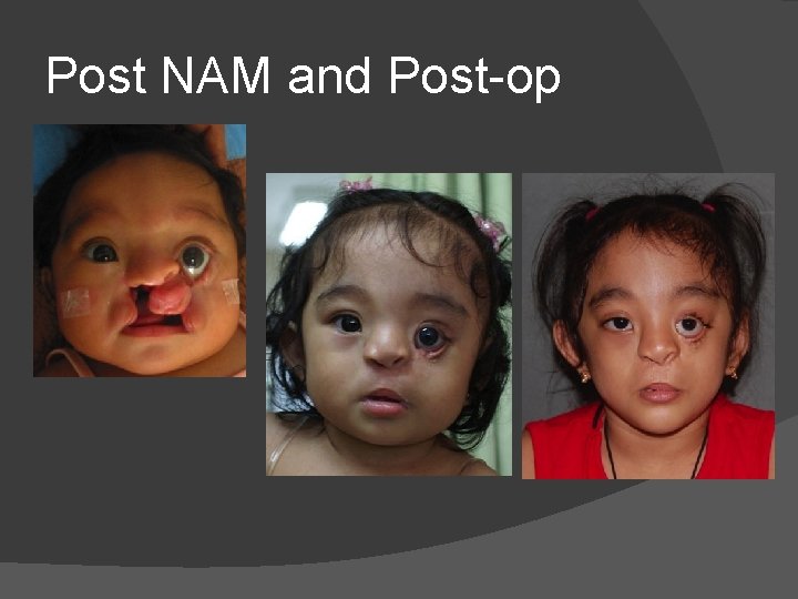 Post NAM and Post-op Post NAM and Post-op