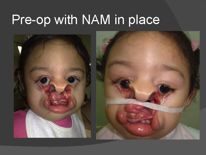 Pre-op with NAM in place Pre-op with NAM in place