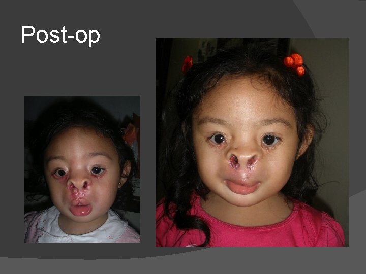 Post-op Post-op