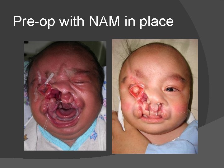 Pre-op with NAM in place Pre-op with NAM in place