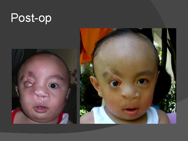 Post-op Post-op