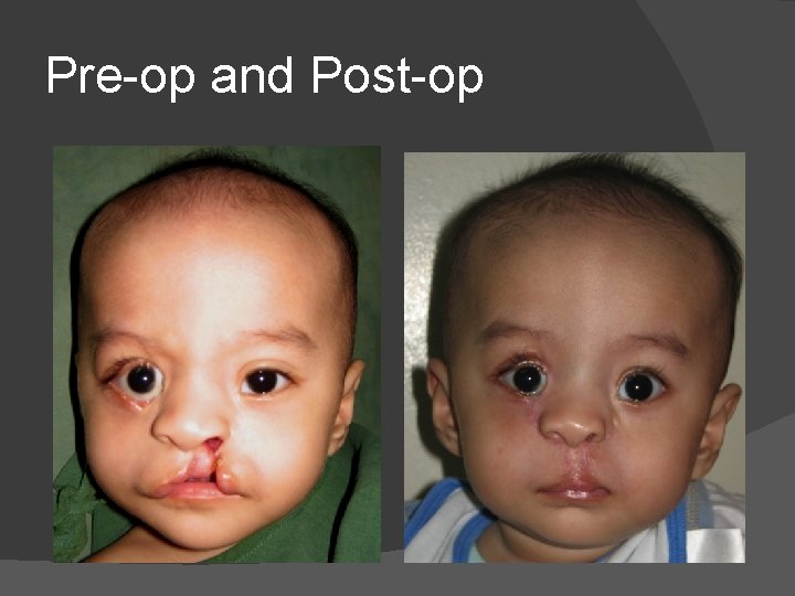 Pre-op and Post-op Pre-op and Post-op