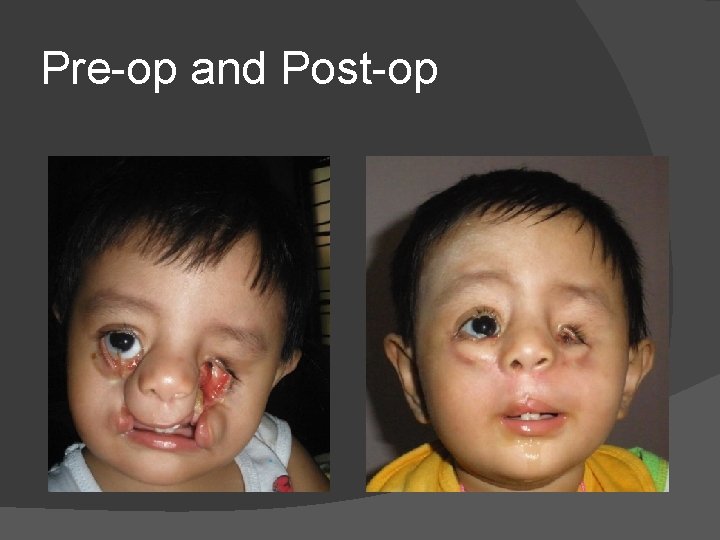 Pre-op and Post-op Pre-op and Post-op