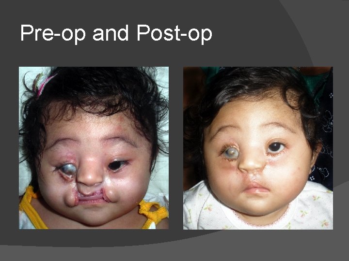 Pre-op and Post-op Pre-op and Post-op