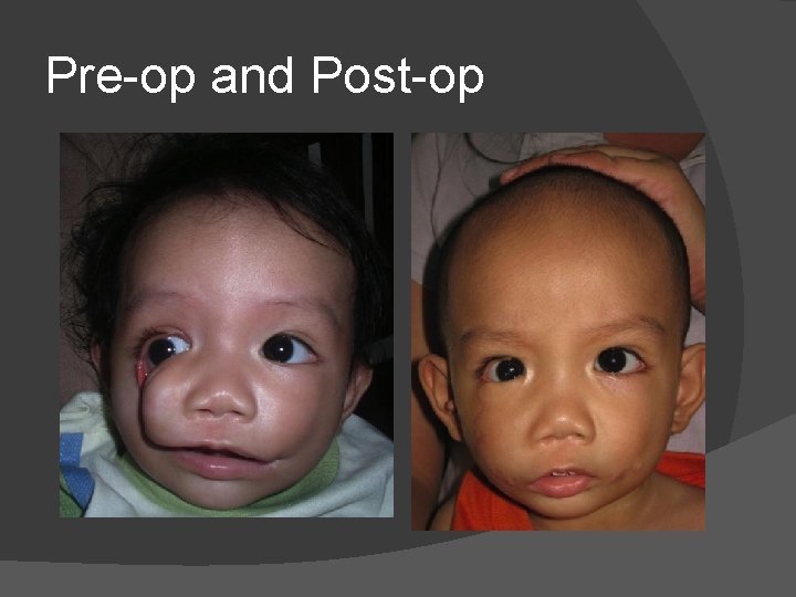 Pre-op and Post-op Pre-op and Post-op
