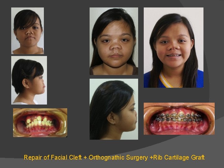 Repair of Facial Cleft + Orthognathic Surgery +Rib Cartilage Graft Repair of Facial Cleft + Orthognathic Surgery +Rib Cartilage Graft