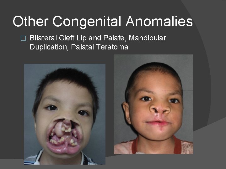 Other Congenital Anomalies � Bilateral Cleft Lip and Palate, Mandibular Duplication, Palatal Teratoma Other Congenital Anomalies � Bilateral Cleft Lip and Palate, Mandibular Duplication, Palatal Teratoma