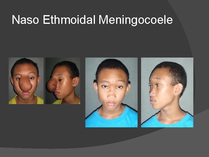 Naso Ethmoidal Meningocoele Naso Ethmoidal Meningocoele