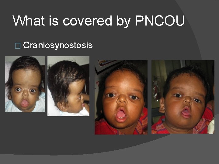 What is covered by PNCOU � Craniosynostosis What is covered by PNCOU � Craniosynostosis