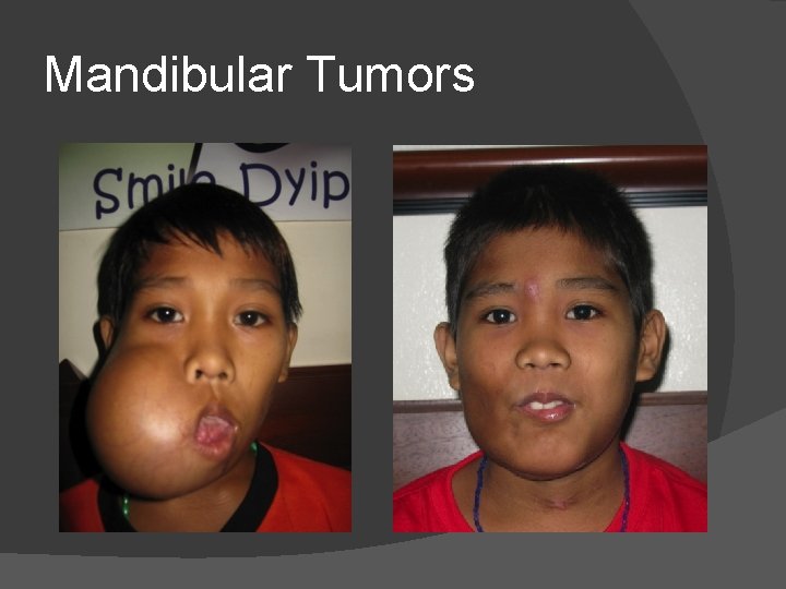 Mandibular Tumors Mandibular Tumors