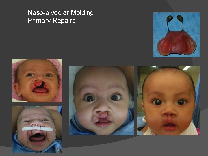 Naso-alveolar Molding Primary Repairs Naso-alveolar Molding Primary Repairs