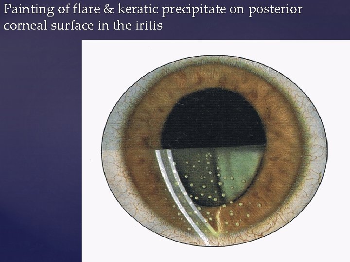Painting of flare & keratic precipitate on posterior corneal surface in the iritis 