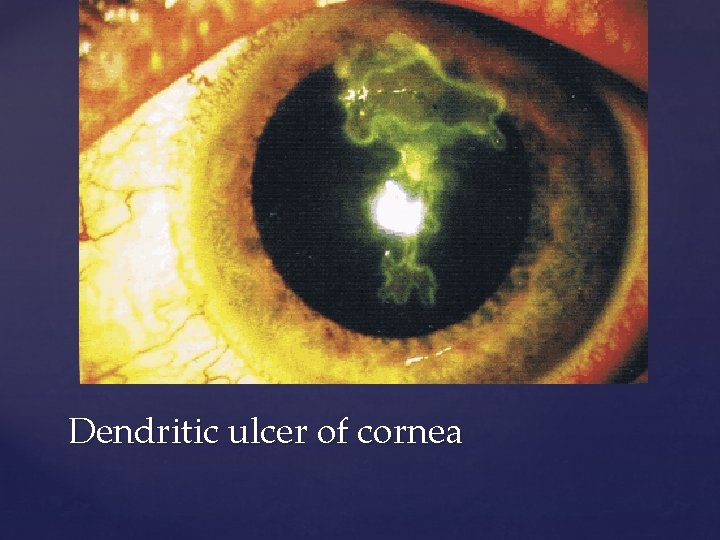 Dendritic ulcer of cornea 