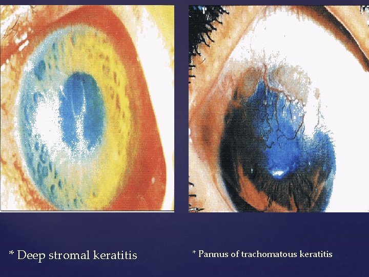 * Deep stromal keratitis * Pannus of trachomatous keratitis 