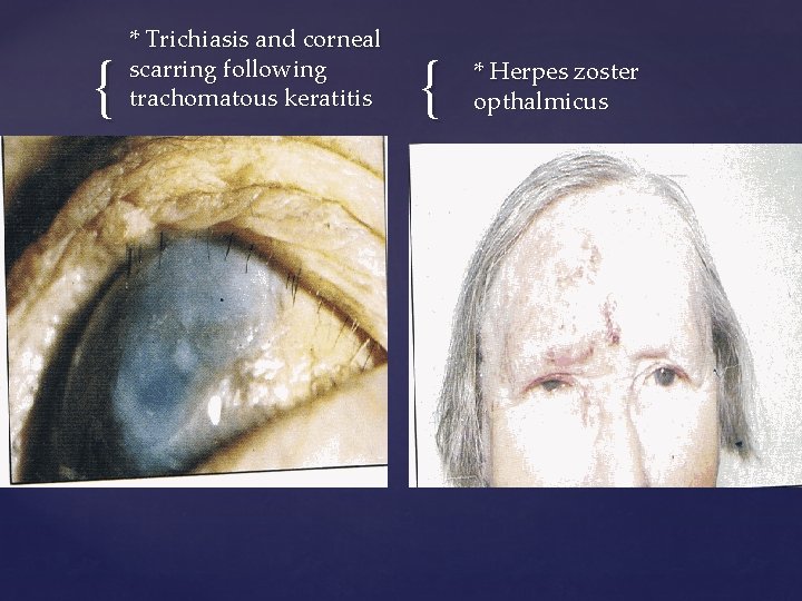 { * Trichiasis and corneal scarring following trachomatous keratitis { * Herpes zoster opthalmicus