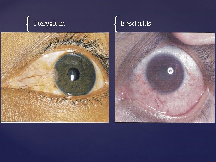 { Pterygium { Epscleritis 