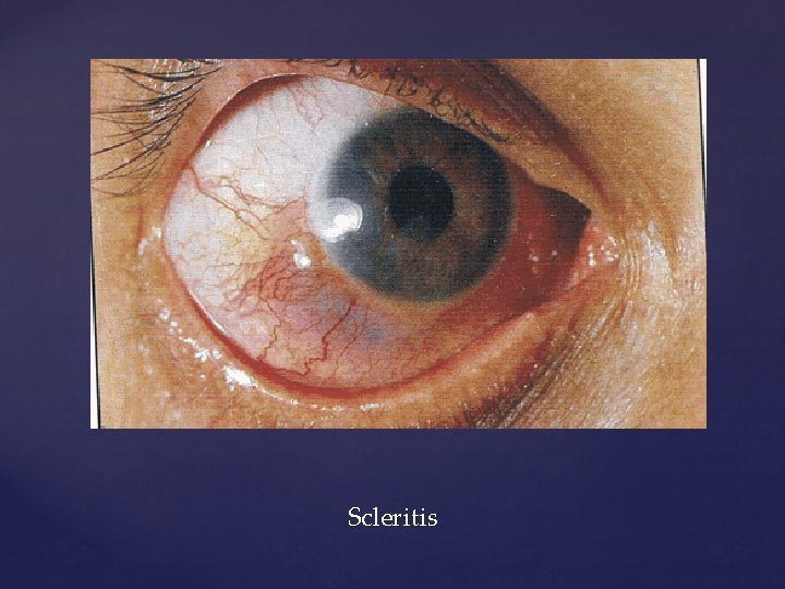 Scleritis 