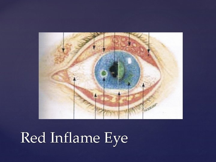 Red Inflame Eye 