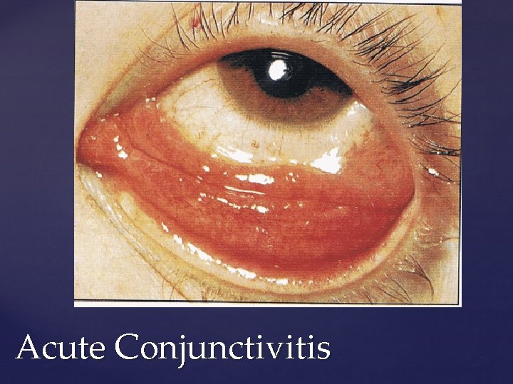 Acute Conjunctivitis 