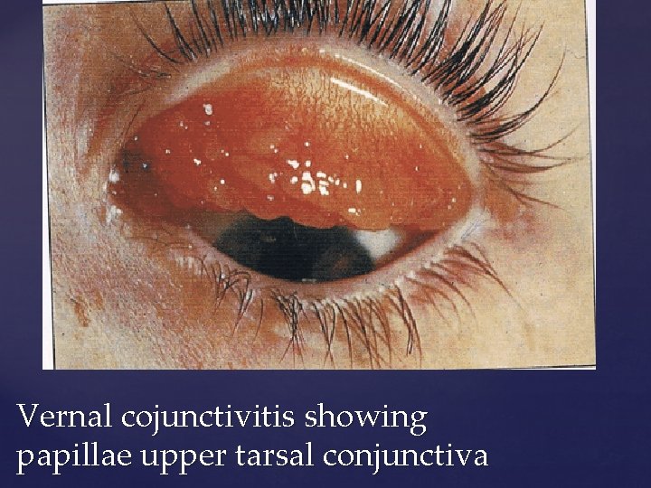 Vernal cojunctivitis showing papillae upper tarsal conjunctiva 
