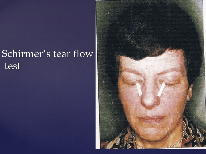 Schirmer’s tear flow test 