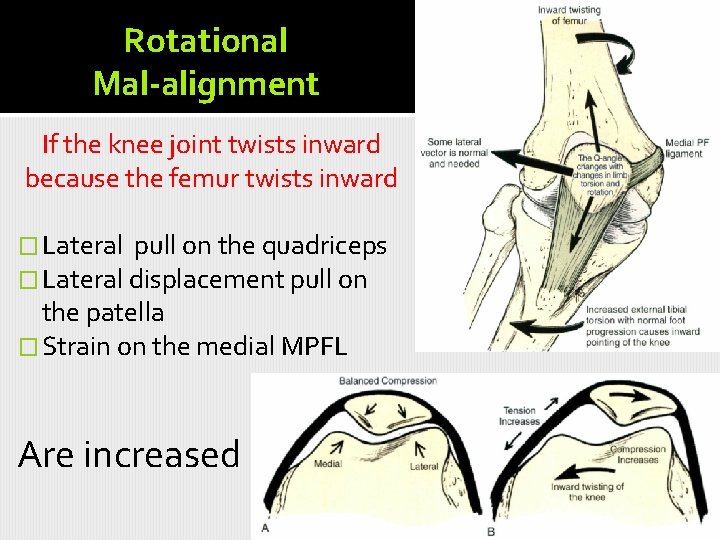 Rotational Mal-alignment If the knee joint twists inward because the femur twists inward �